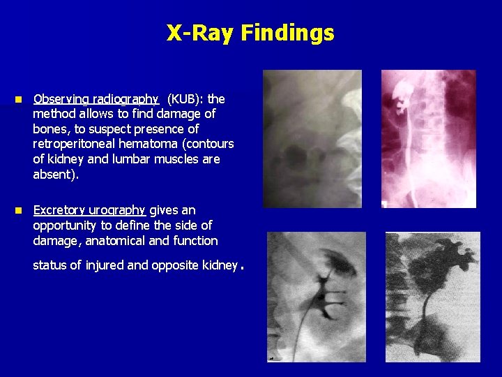 X-Ray Findings n Observing radiography (KUB): the method allows to find damage of bones,