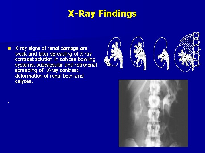 X-Ray Findings n . X-ray signs of renal damage are weak and later spreading