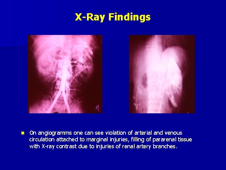 X-Ray Findings n On angiogramms one can see violation of arterial and venous circulation