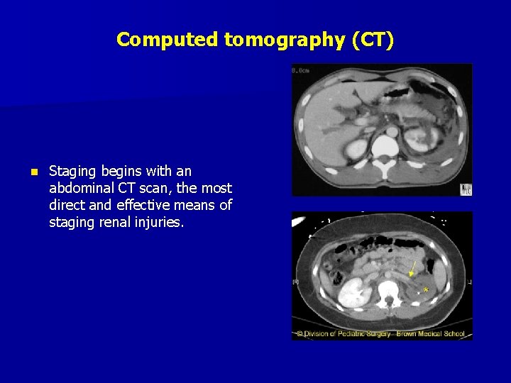 Computed tomography (CT) n Staging begins with an abdominal CT scan, the most direct