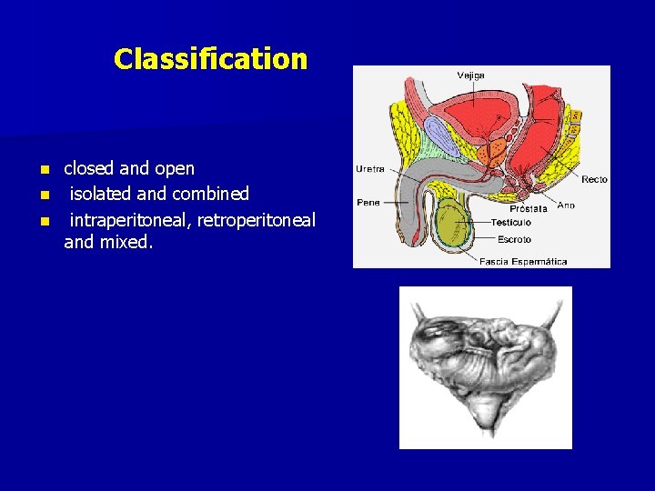 Classification closed and open n isolated and combined n intraperitoneal, retroperitoneal and mixed. n