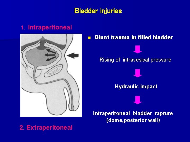 Bladder injuries 1. Intraperitoneal n Blunt trauma in filled bladder Rising of intravesical pressure