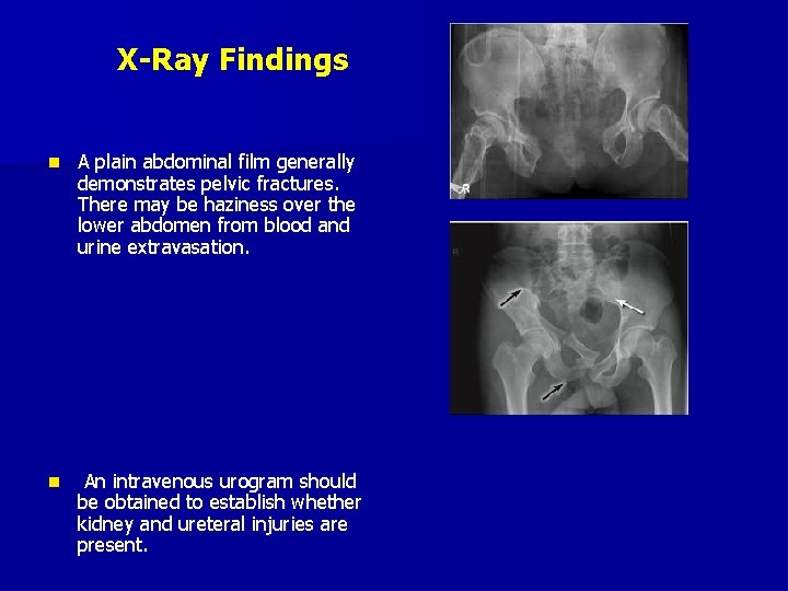 X-Ray Findings n A plain abdominal film generally demonstrates pelvic fractures. There may be