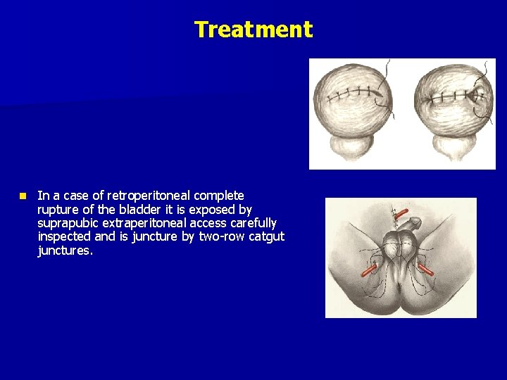 Treatment n In a case of retroperitoneal complete rupture of the bladder it is