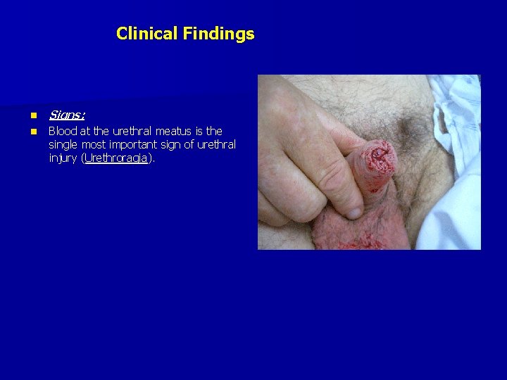 Clinical Findings n Signs: n Blood at the urethral meatus is the single most