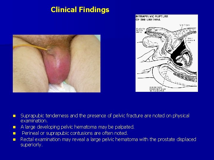 Clinical Findings n n Suprapubic tenderness and the presence of pelvic fracture are noted