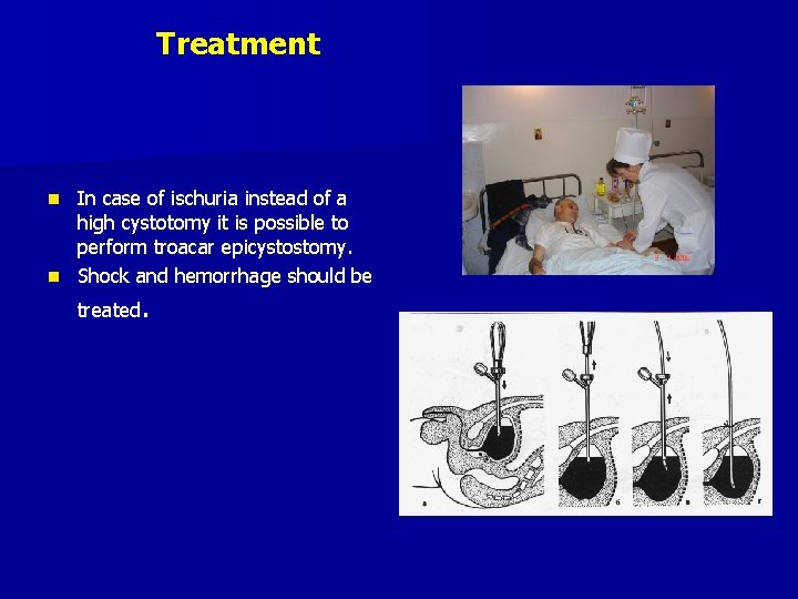 Treatment In case of ischuria instead of a high cystotomy it is possible to