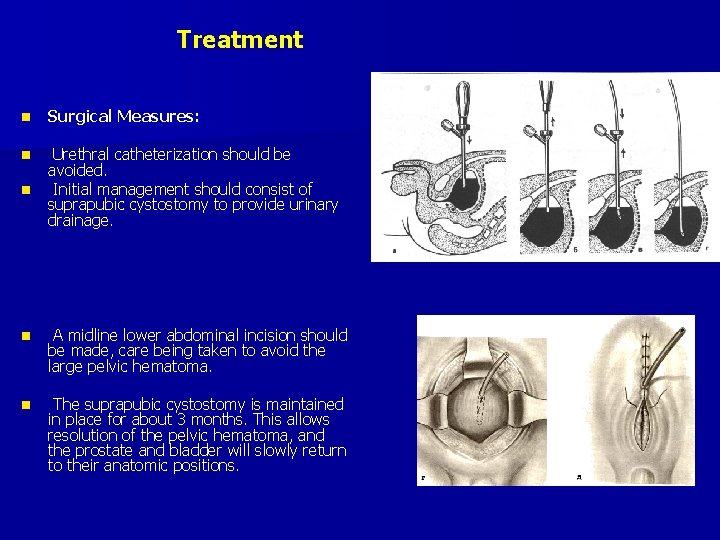 Treatment n Surgical Measures: n Urethral catheterization should be avoided. Initial management should consist