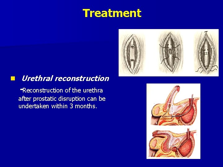 Treatment n Urethral reconstruction -Reconstruction of the urethra after prostatic disruption can be undertaken