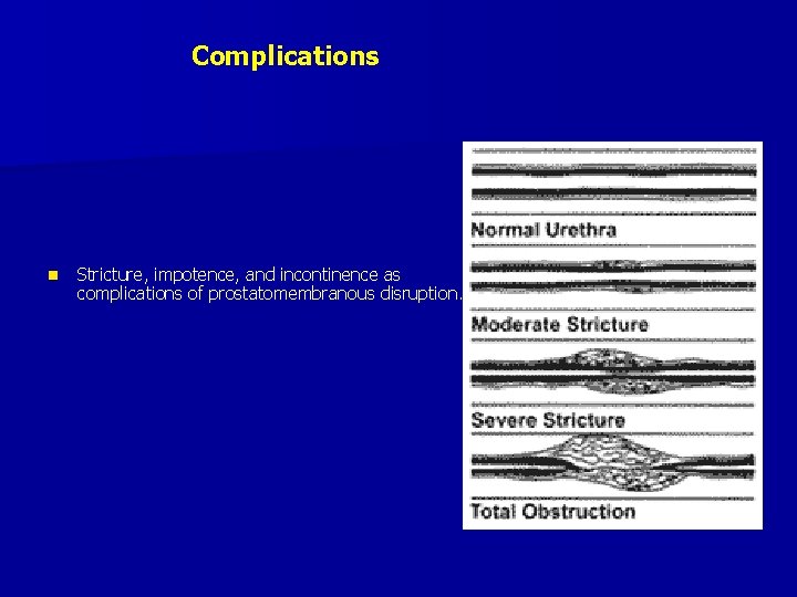 Complications n Stricture, impotence, and incontinence as complications of prostatomembranous disruption. 