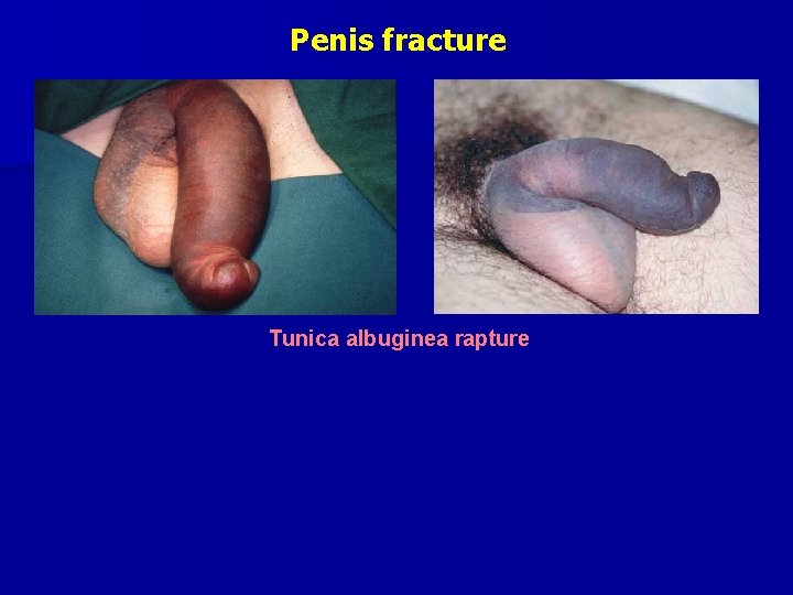 Penis fracture Tunica albuginea rapture 