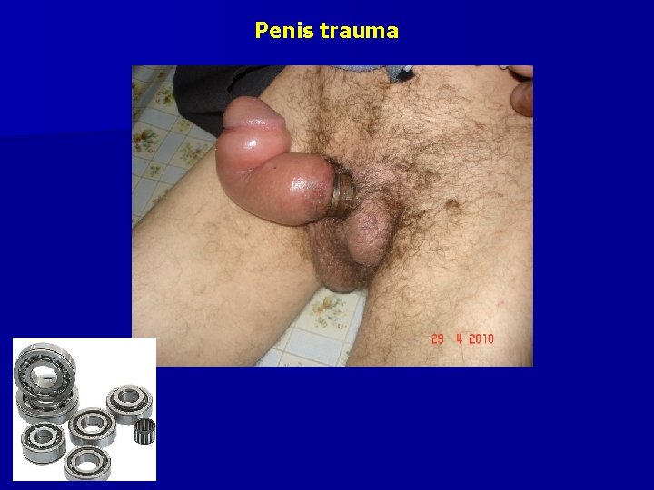 Penis trauma 