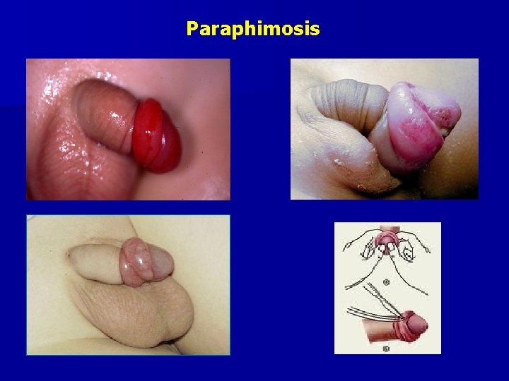 Paraphimosis 