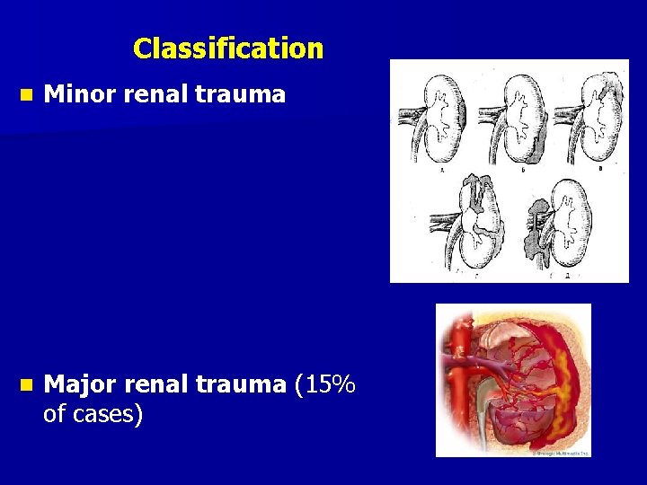 Classification n Minor renal trauma n Major renal trauma (15% of cases) 