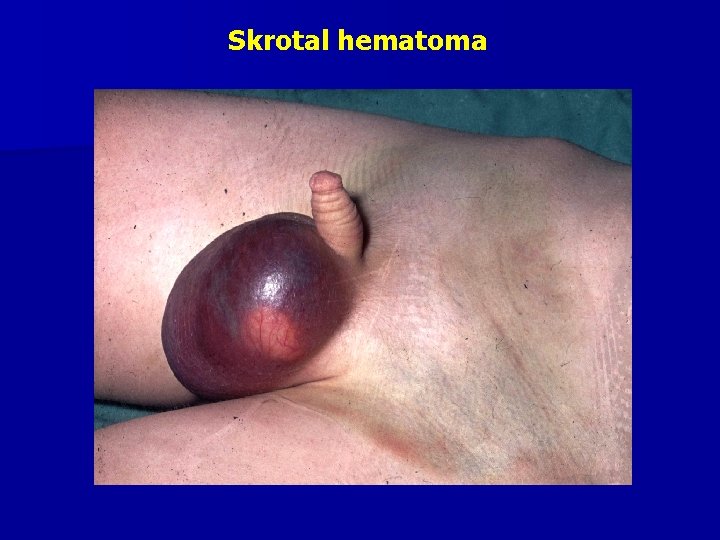 Skrotal hematoma 