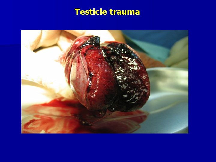 Testicle trauma 