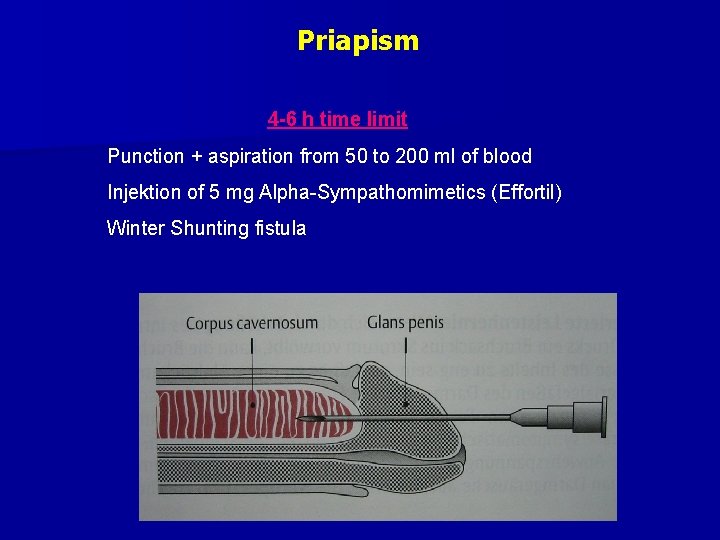 Priapism 4 -6 h time limit Punction + aspiration from 50 to 200 ml