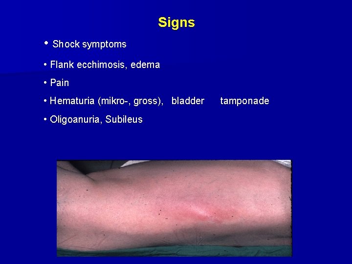 Signs • Shock symptoms • Flank ecchimosis, edema • Pain • Hematuria (mikro-, gross),