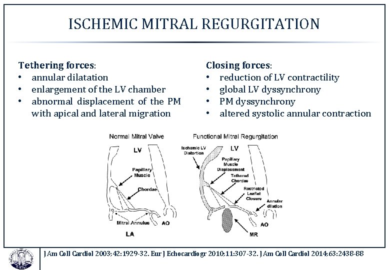 ISCHEMIC MITRAL REGURGITATION Tethering forces: • annular dilatation • enlargement of the LV chamber