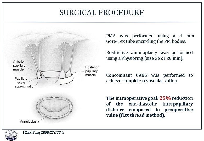 SURGICAL PROCEDURE PMA was performed using a 4 mm Gore-Tex tube encircling the PM