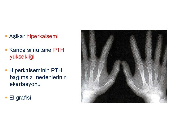 Diagnostik kriterler Aşikar hiperkalsemi Kanda simültane PTH yüksekliği Hiperkalseminin PTH- bağımsız nedenlerinin ekartasyonu El