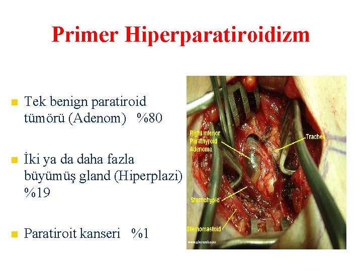 Primer Hiperparatiroidizm Tek benign paratiroid tümörü (Adenom) %80 İki ya da daha fazla büyümüş