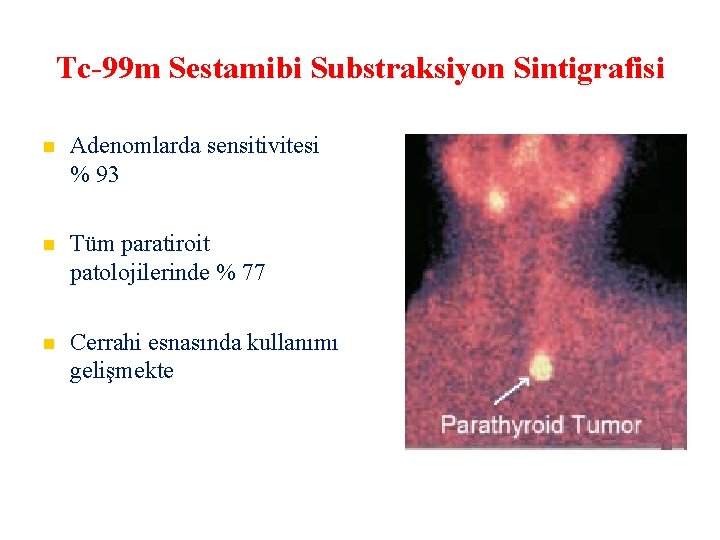 Tc-99 m Sestamibi Substraksiyon Sintigrafisi Adenomlarda sensitivitesi % 93 Tüm paratiroit patolojilerinde % 77