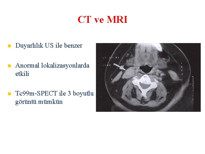 CT ve MRI Duyarlılık US ile benzer Anormal lokalizasyonlarda etkili Tc 99 m-SPECT ile