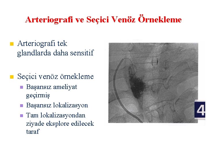 Arteriografi ve Seçici Venöz Örnekleme Arteriografi tek glandlarda daha sensitif Seçici venöz örnekleme Başarısız