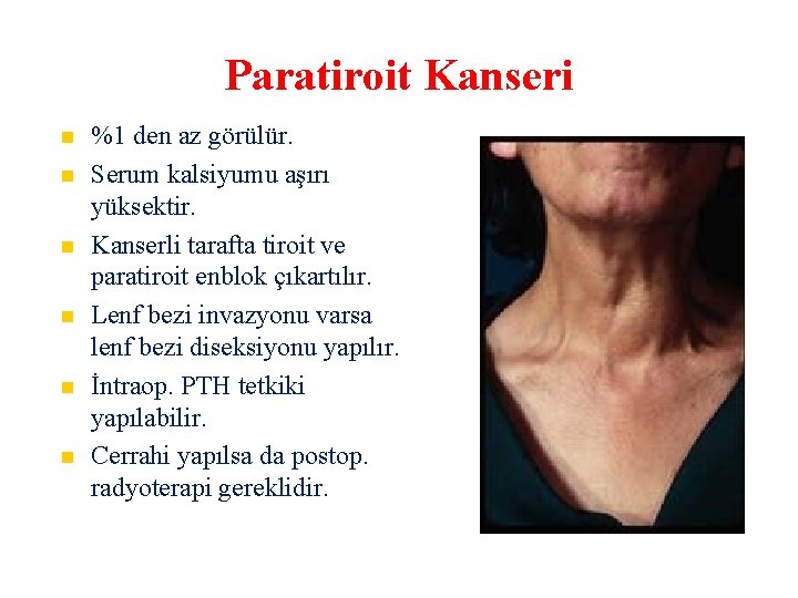 Paratiroit Kanseri %1 den az görülür. Serum kalsiyumu aşırı yüksektir. Kanserli tarafta tiroit ve