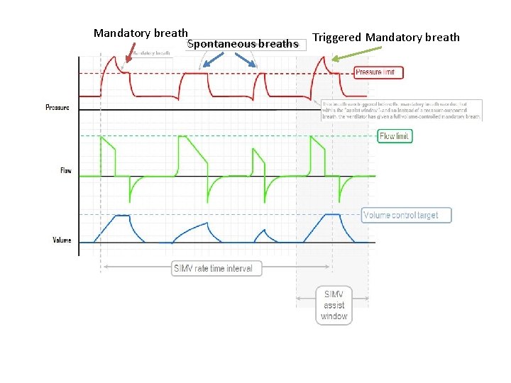 Mandatory breath Spontaneous breaths Triggered Mandatory breath 