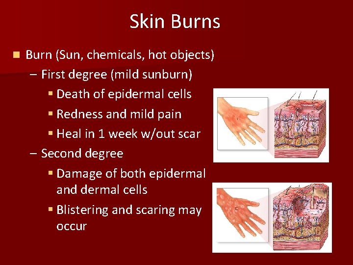 Skin Burns n Burn (Sun, chemicals, hot objects) – First degree (mild sunburn) §