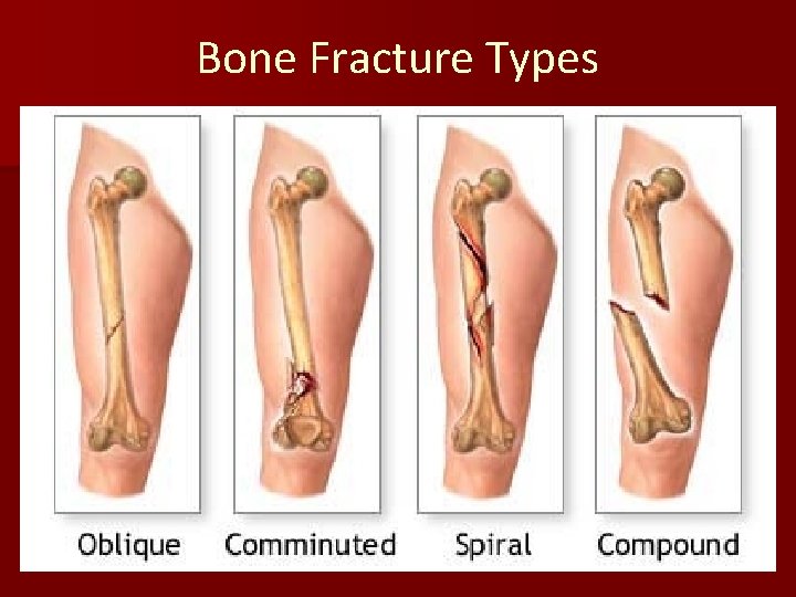 Bone Fracture Types 