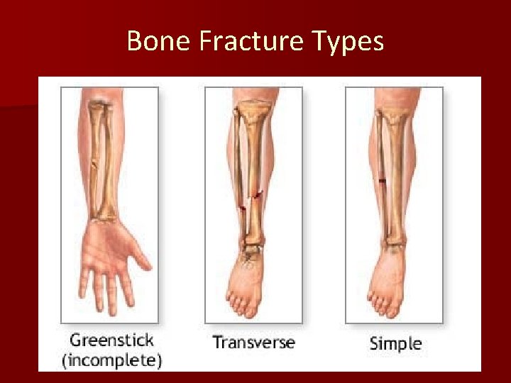 Bone Fracture Types 