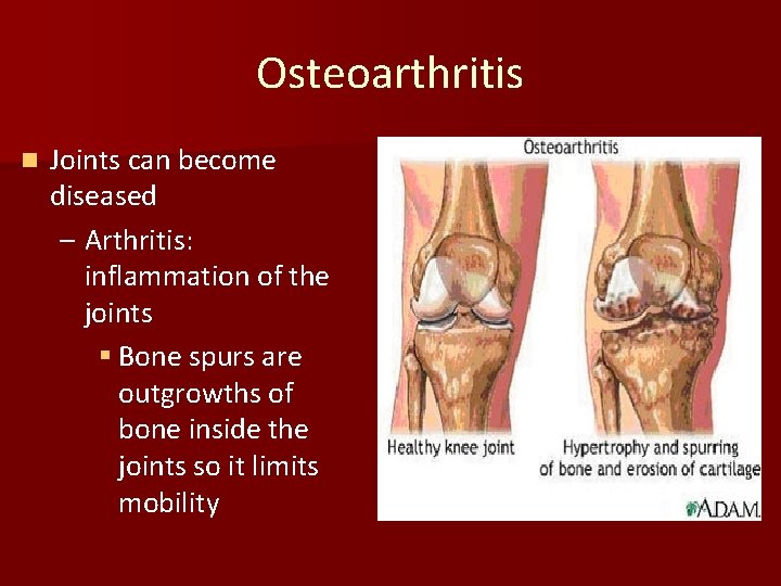 Osteoarthritis n Joints can become diseased – Arthritis: inflammation of the joints § Bone