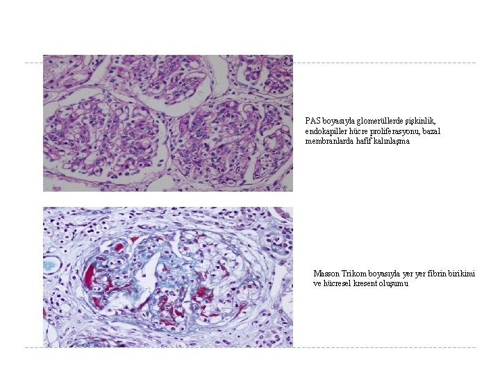 PAS boyasıyla glomerüllerde şişkinlik, endokapiller hücre proliferasyonu, bazal membranlarda hafif kalınlaşma Masson Trikom boyasıyla