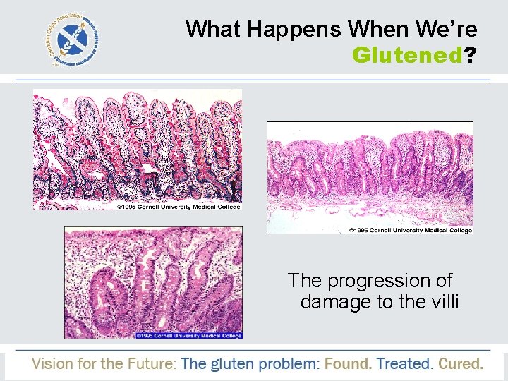 What Happens When We’re Glutened? The progression of damage to the villi 