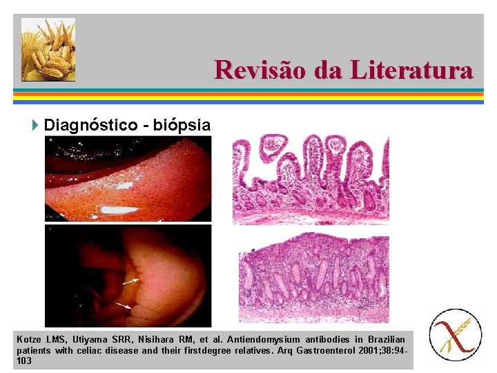 Revisão da Literatura 4 Diagnóstico - biópsia Kotze LMS, Utiyama SRR, Nisihara RM, et