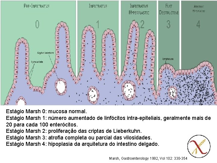 Revisão da Literatura 4 Diagnóstico - biópsia Estágio Marsh 0: mucosa normal. Estágio Marsh