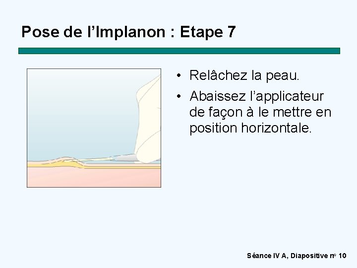 Pose de l’Implanon : Etape 7 • Relâchez la peau. • Abaissez l’applicateur de