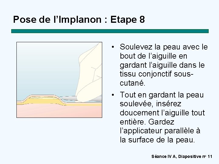 Pose de l’Implanon : Etape 8 • Soulevez la peau avec le bout de