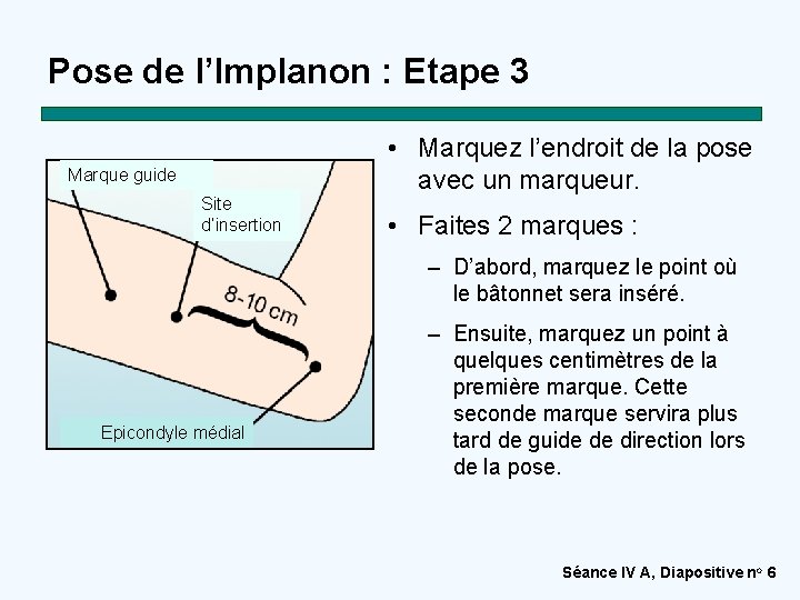 Pose de l’Implanon : Etape 3 Marque guide Site d’insertion • Marquez l’endroit de