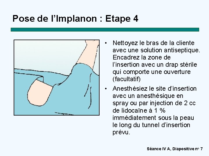 Pose de l’Implanon : Etape 4 • Nettoyez le bras de la cliente avec