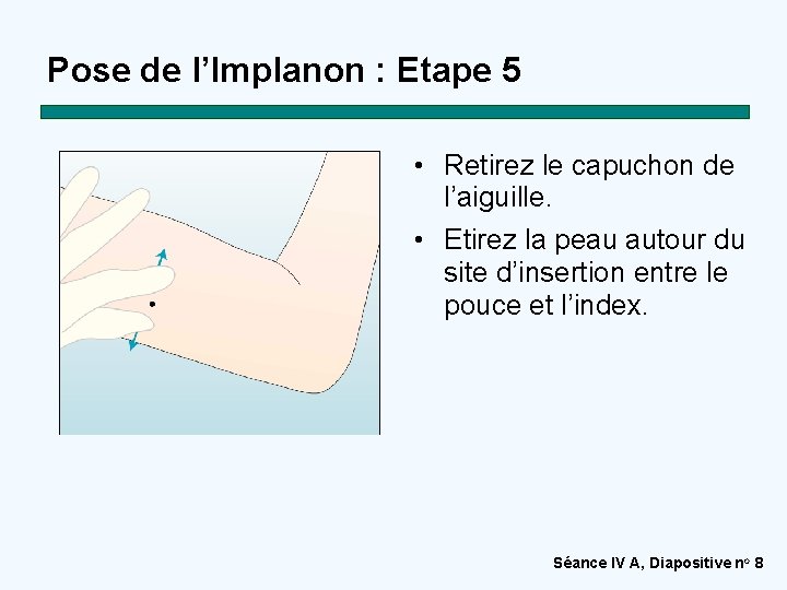 Pose de l’Implanon : Etape 5 • Retirez le capuchon de l’aiguille. • Etirez