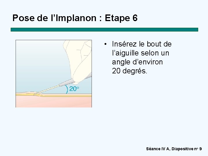 Pose de l’Implanon : Etape 6 • Insérez le bout de l’aiguille selon un