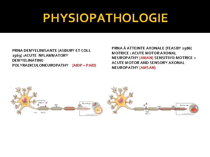 PHYSIOPATHOLOGIE PRNA DEMYELINISANTE (ASBURY ET COLL 1969) : ACUTE NFLAMMATORY DEMYELINATING POLYRADICULONEUROPATHY (AIDP =