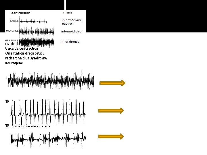 RESULTATS ENMG mode de détection simple : tracé de contraction Orientation diagnostic : recherche