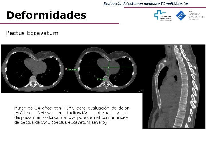 Evaluación del esternón mediante TC multidetector Deformidades Pectus Excavatum Mujer de 34 años con