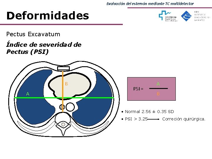 Evaluación del esternón mediante TC multidetector Deformidades Pectus Excavatum Índice de severidad de Pectus