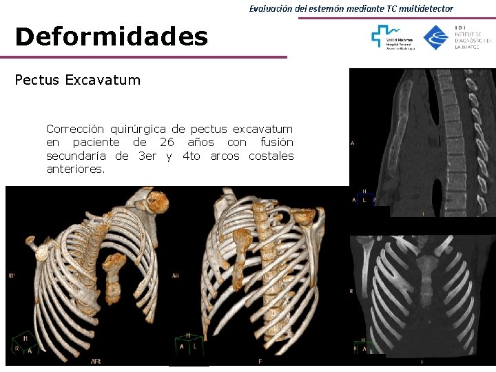 Evaluación del esternón mediante TC multidetector Deformidades Pectus Excavatum Corrección quirúrgica de pectus excavatum